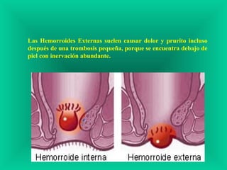Las Hemorroides Externas suelen causar dolor y prurito incluso
después de una trombosis pequeña, porque se encuentra debajo de
piel con inervación abundante.
 