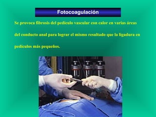 Se provoca fibrosis del pedículo vascular con calor en varias áreas
del conducto anal para lograr el mismo resultado que la ligadura en
pedículos más pequeños.
Fotocoagulación
 