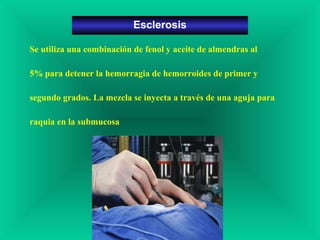 Se utiliza una combinación de fenol y aceite de almendras al
5% para detener la hemorragia de hemorroides de primer y
segundo grados. La mezcla se inyecta a través de una aguja para
raquia en la submucosa
Esclerosis
 