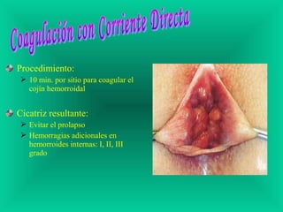 Procedimiento:
 10 min. por sitio para coagular el
cojín hemorroidal
Cicatriz resultante:
 Evitar el prolapso
 Hemorragias adicionales en
hemorroides internas: I, II, III
grado
 