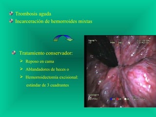 Trombosis aguda
Incarceración de hemorroides mixtas
Tratamiento conservador:
 Reposo en cama
 Ablandadores de heces o
 Hemorroidectomía excisional:
estándar de 3 cuadrantes
 