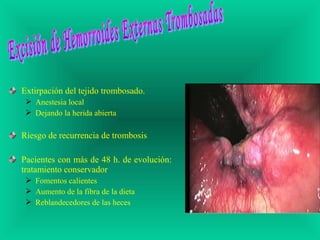 Extirpación del tejido trombosado.
 Anestesia local
 Dejando la herida abierta
Riesgo de recurrencia de trombosis
Pacientes con más de 48 h. de evolución:
tratamiento conservador
 Fomentos calientes
 Aumento de la fibra de la dieta
 Reblandecedores de las heces
 