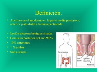 Definición.
• Abertura en el anodermo en la parte media posterior o
anterior justo distal a la línea pectineada.
• Lesión ulcerosa benigna situada:
• Comisura posterior del ano 90 %
• 10% anteriores
• 1 % ambas
• Son aisladas
 