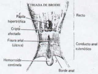 TRIADA DE BRODIE
1
2
3
 