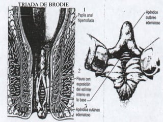 TRIADA DE BRODIE
1
2
3
 