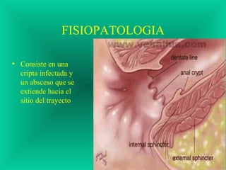 FISIOPATOLOGIA
• Consiste en una
cripta infectada y
un absceso que se
extiende hacia el
sitio del trayecto
 