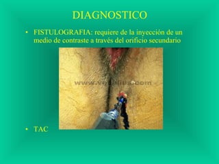 DIAGNOSTICO
• FISTULOGRAFIA: requiere de la inyección de un
medio de contraste a través del orificio secundario
• TAC
 