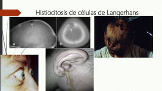 Histiocitosis de células de Langerhans
 