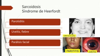 Sarcoidosis
Síndrome de Heerfordt
Parotiditis
Uveítis, fiebre
Parálisis facial
 