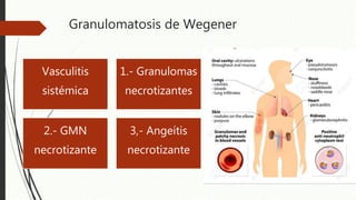 Granulomatosis de Wegener
Vasculitis
sistémica
1.- Granulomas
necrotizantes
2.- GMN
necrotizante
3,- Angeítis
necrotizante
 