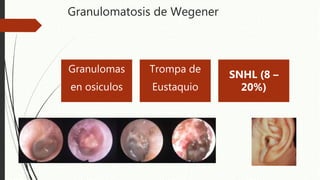 Granulomatosis de Wegener
Granulomas
en osiculos
Trompa de
Eustaquio
SNHL (8 –
20%)
 