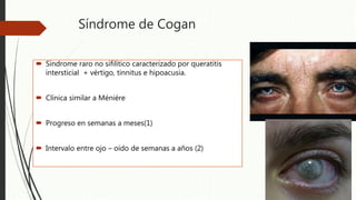 Síndrome de Cogan
 Síndrome raro no sifilítico caracterizado por queratitis
intersticial + vértigo, tinnitus e hipoacusia.
 Clínica similar a Méniére
 Progreso en semanas a meses(1)
 Intervalo entre ojo – oído de semanas a años (2)
 