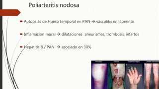 Poliarteritis nodosa
 Autopsias de Hueso temporal en PAN  vasculitis en laberinto
 Inflamación mural  dilataciones aneurismas, trombosis, infartos
 Hepatitis B / PAN  asociado en 30%
 