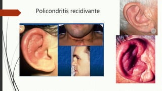 Policondritis recidivante
 