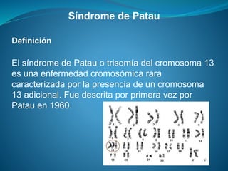 Síndrome de Patau
Definición
El síndrome de Patau o trisomía del cromosoma 13
es una enfermedad cromosómica rara
caracterizada por la presencia de un cromosoma
13 adicional. Fue descrita por primera vez por
Patau en 1960.
 