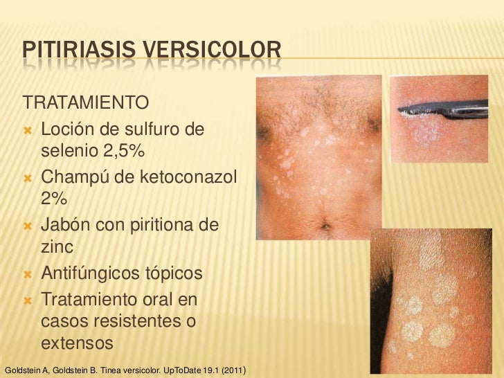 Natural Remedies For Indented Acne Scars Natural Remedies For Indented Acne Scars