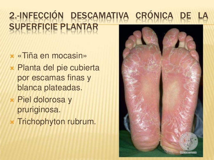 Que médico del hongo de las uñas