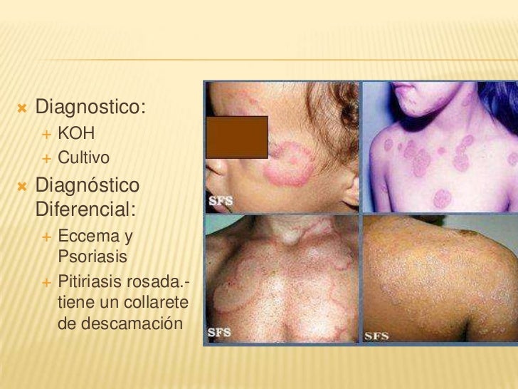 La psoriasis de los rincones de los labios
