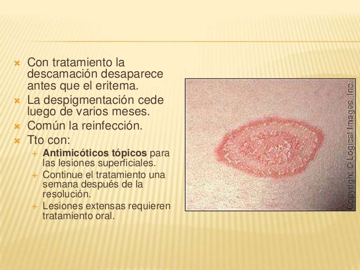 La psoriasis la destrucción de los huesos