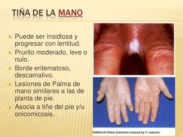 Las causas del surgimiento de la eccema en los pies