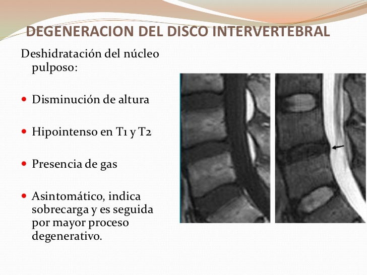 El dolor en la espalda bajo la espátula izquierda del ejercicio