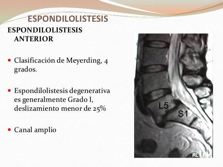 Enfermedades Degenerativas Lumbar Enfermedades Degenerativas Lumbar