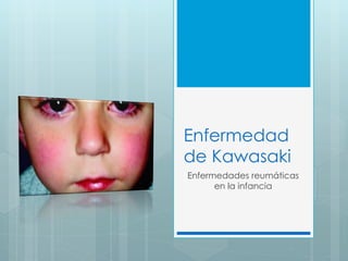 Enfermedad
de Kawasaki
Enfermedades reumáticas
en la infancia
 