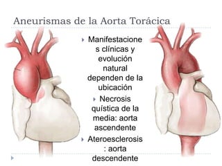 Aneurismas de la Aorta Torácica
 Manifestacione
s clínicas y
evolución
natural
dependen de la
ubicación
 Necrosis
quística de la
media: aorta
ascendente
 Ateroesclerosis
: aorta
descendente
 