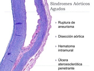 Síndromes Aórticos
Agudos
 Ruptura de
aneurisma
 Disección aórtica
 Hematoma
intramural
 Úlcera
ateroesclerótica
penetrante
 