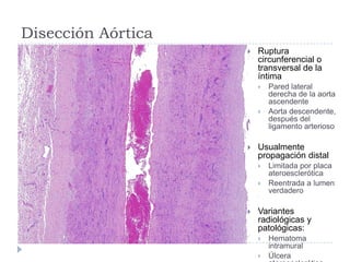 Disección Aórtica
 Ruptura
circunferencial o
transversal de la
íntima
 Pared lateral
derecha de la aorta
ascendente
 Aorta descendente,
después del
ligamento arterioso
 Usualmente
propagación distal
 Limitada por placa
ateroesclerótica
 Reentrada a lumen
verdadero
 Variantes
radiológicas y
patológicas:
 Hematoma
intramural
 Úlcera
 