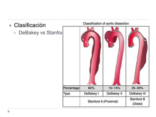  Clasificación
 DeBakey vs Stanford
 