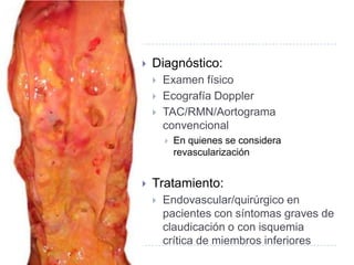  Diagnóstico:
 Examen físico
 Ecografía Doppler
 TAC/RMN/Aortograma
convencional
 En quienes se considera
revascularización
 Tratamiento:
 Endovascular/quirúrgico en
pacientes con síntomas graves de
claudicación o con isquemia
crítica de miembros inferiores
 
