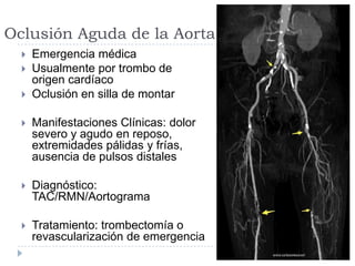 Oclusión Aguda de la Aorta
 Emergencia médica
 Usualmente por trombo de
origen cardíaco
 Oclusión en silla de montar
 Manifestaciones Clínicas: dolor
severo y agudo en reposo,
extremidades pálidas y frías,
ausencia de pulsos distales
 Diagnóstico:
TAC/RMN/Aortograma
 Tratamiento: trombectomía o
revascularización de emergencia
 