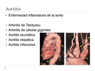 Aortitis
 Enfermedad inflamatoria de la aorta
 Arteritis de Takayasu
 Arteritis de células gigantes
 Aortitis reumática
 Aortitis idopática
 Aortitis infecciosa
 