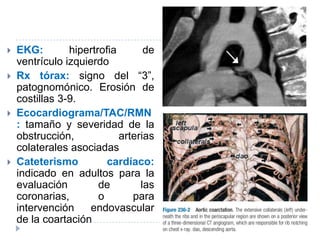  EKG: hipertrofia de
ventrículo izquierdo
 Rx tórax: signo del “3”,
patognomónico. Erosión de
costillas 3-9.
 Ecocardiograma/TAC/RMN
: tamaño y severidad de la
obstrucción, arterias
colaterales asociadas
 Cateterismo cardíaco:
indicado en adultos para la
evaluación de las
coronarias, o para
intervención endovascular
de la coartación
 