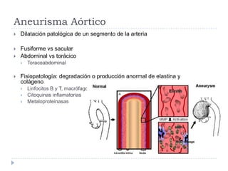 Aneurisma Aórtico
 Dilatación patológica de un segmento de la arteria
 Fusiforme vs sacular
 Abdominal vs torácico
 Toracoabdominal
 Fisiopatología: degradación o producción anormal de elastina y
colágeno
 Linfocitos B y T, macrófagos
 Citoquinas inflamatorias
 Metaloproteinasas
 
