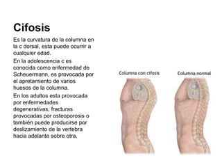 Cifosis
Es la curvatura de la columna en
la c dorsal, esta puede ocurrir a
cualquier edad.
En la adolescencia c es
conocid...