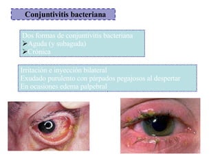 <ul><ul><li>Conjuntivitis bacteriana </li></ul></ul><ul><li>Dos formas de conjuntivitis bacteriana </li></ul><ul><li>Aguda...