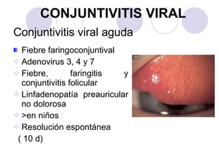 Conjuntivitis viral aguda <ul><li>Fiebre faringoconjuntival </li></ul><ul><li>Adenovirus 3, 4 y 7 </li></ul><ul><li>Fiebre...