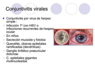 Conjuntivitis virales <ul><li>Conjuntivitis por virus de herpes simple : </li></ul><ul><li>Infección 1º con HSV o infeccio...