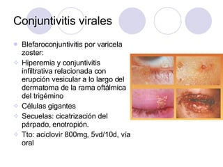Conjuntivitis virales <ul><li>Blefaroconjuntivitis por varicela zoster: </li></ul><ul><li>Hiperemia y conjuntivitis infilt...