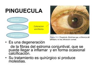 PINGUECULA <ul><li>Es una degeneración  </li></ul><ul><li>de la fibras del estroma conjuntival, que se puede llegar a infl...