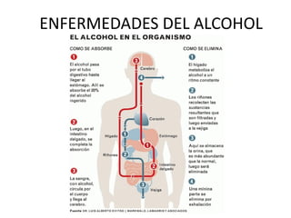 ENFERMEDADES DEL ALCOHOL
 