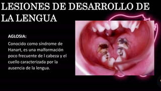 AGLOSIA:
Conocido como síndrome de
Hanart, es una malformación
poco frecuente de l cabeza y el
cuello caracterizada por la
ausencia de la lengua.
LESIONES DE DESARROLLO DE
LA LENGUA
 