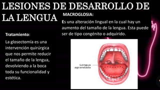 MACROGLOSIA:
Es una alteración lingual en la cual hay un
aumento del tamaño de la lengua. Esta puede
ser de tipo congénito o adquirido.
LESIONES DE DESARROLLO DE
LA LENGUA
Tratamiento:
La glosectomía es una
intervención quirúrgica
que nos permite reducir
el tamaño de la lengua,
devolviendo a la boca
toda su funcionalidad y
estética.
 