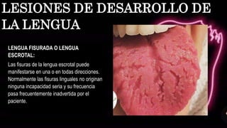 LENGUA FISURADA O LENGUA
ESCROTAL:
Las fisuras de la lengua escrotal puede
manifestarse en una o en todas direcciones.
Normalmente las fisuras linguales no originan
ninguna incapacidad seria y su frecuencia
pasa frecuentemente inadvertida por el
paciente.
LESIONES DE DESARROLLO DE
LA LENGUA
 