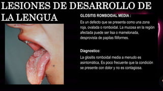 GLOSITIS ROMBOIDAL MEDIA :
Es un defecto que se presenta como una zona
roja, ovalada o romboidal. La mucosa en la región
afectada puede ser lisa o mamelonada,
desprovista de papilas filiformes.
Diagnostico:
La glositis romboidal media a menudo es
asintomática, Es poco frecuente que la condición
se presente con dolor y no es contagiosa.
LESIONES DE DESARROLLO DE
LA LENGUA
 