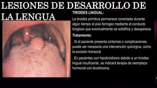 TIROIDES LINGUAL:
La tiroides primitiva permanece conectada durante
algún tiempo al piso faríngeo mediante el conducto
tirogloso que eventualmente se solidifica y desaparece.
Tratamiento:
. Si el paciente presenta síntomas o complicaciones,
puede ser necesaria una intervención quirúrgica, como
la excisión transoral
. En pacientes con hipotiroidismo debido a un tiroides
lingual insuficiente, se indicará terapia de reemplazo
hormonal con levotiroxina.
LESIONES DE DESARROLLO DE
LA LENGUA
 
