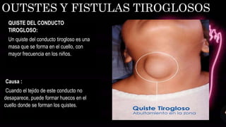 OUTSTES Y FISTULAS TIROGLOSOS
Causa :
Cuando el tejido de este conducto no
desaparece, puede formar huecos en el
cuello donde se forman los quistes.
QUISTE DEL CONDUCTO
TIROGLOSO:
Un quiste del conducto tirogloso es una
masa que se forma en el cuello, con
mayor frecuencia en los niños.
 