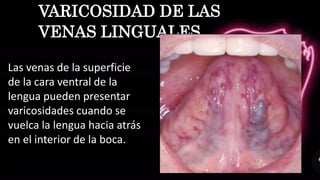 VARICOSIDAD DE LAS
VENAS LINGUALES
Las venas de la superficie
de la cara ventral de la
lengua pueden presentar
varicosidades cuando se
vuelca la lengua hacia atrás
en el interior de la boca.
 